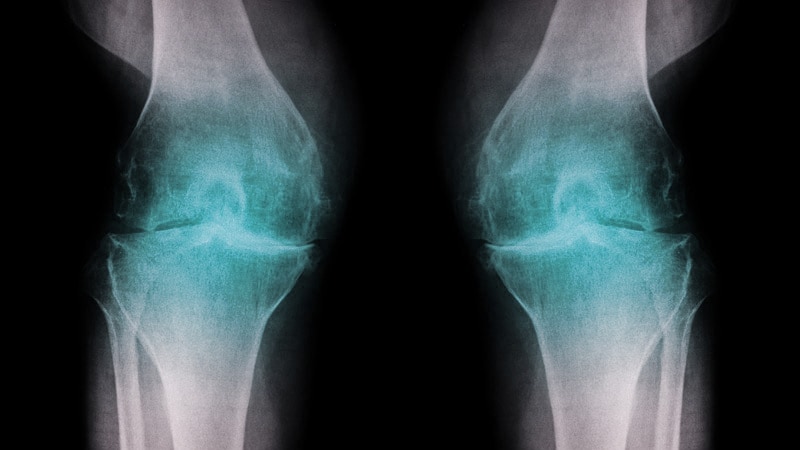 dt_181217_osteoarthritis_knee_800x450.jpg